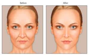6 فوائد لحقن الدهون في الوجه